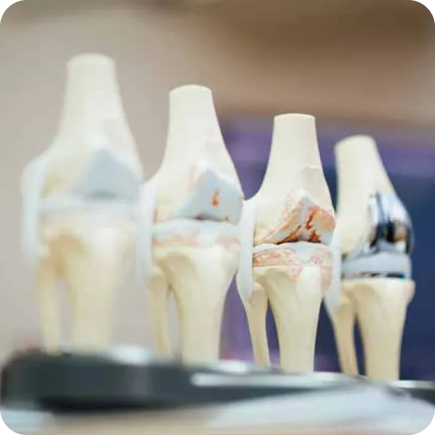 Anatomical knee joint models showing progression to replacement